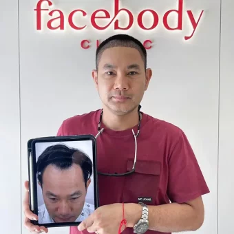 รีวิวปลูกผม (25)