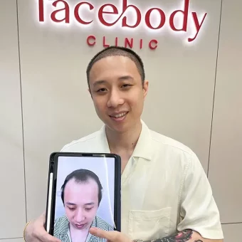 รีวิวปลูกผม (26)