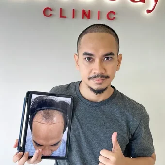 รีวิวปลูกผม (27)