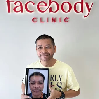 รีวิวปลูกผม (28)